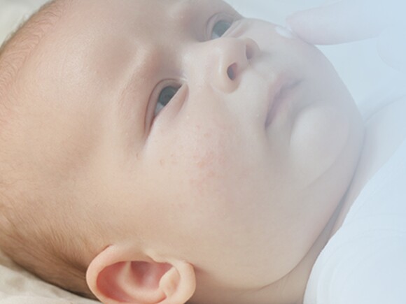 Baby allergies – Ask the expert
